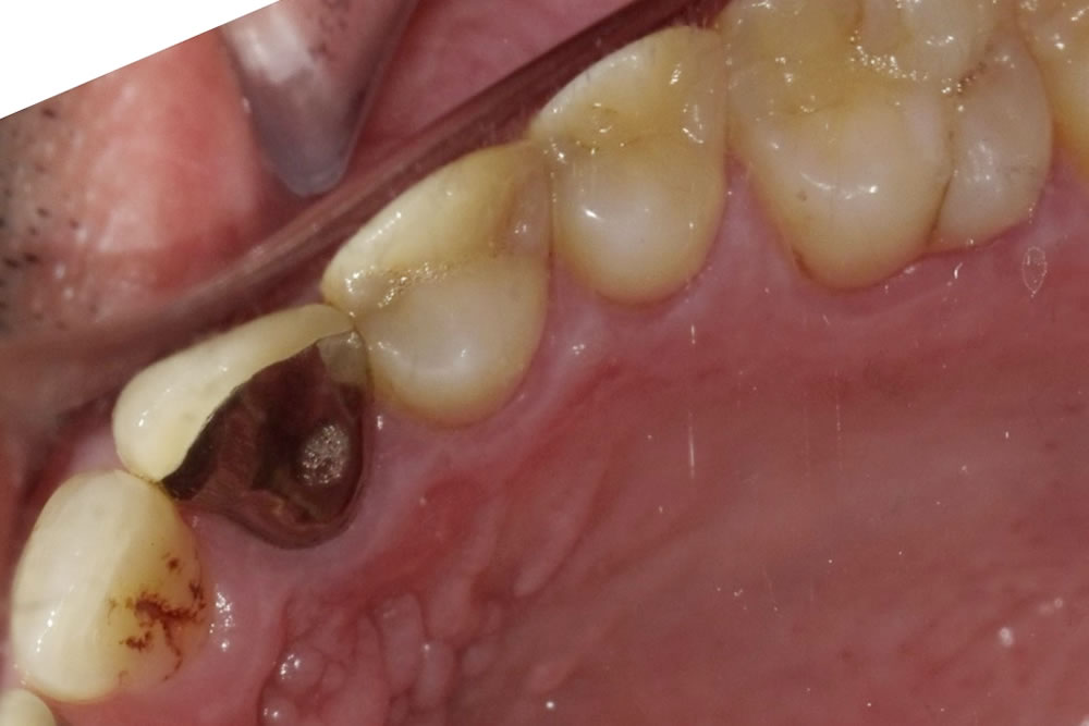 生活歯髄断髄法(バイタルパルプセラピー)の症例