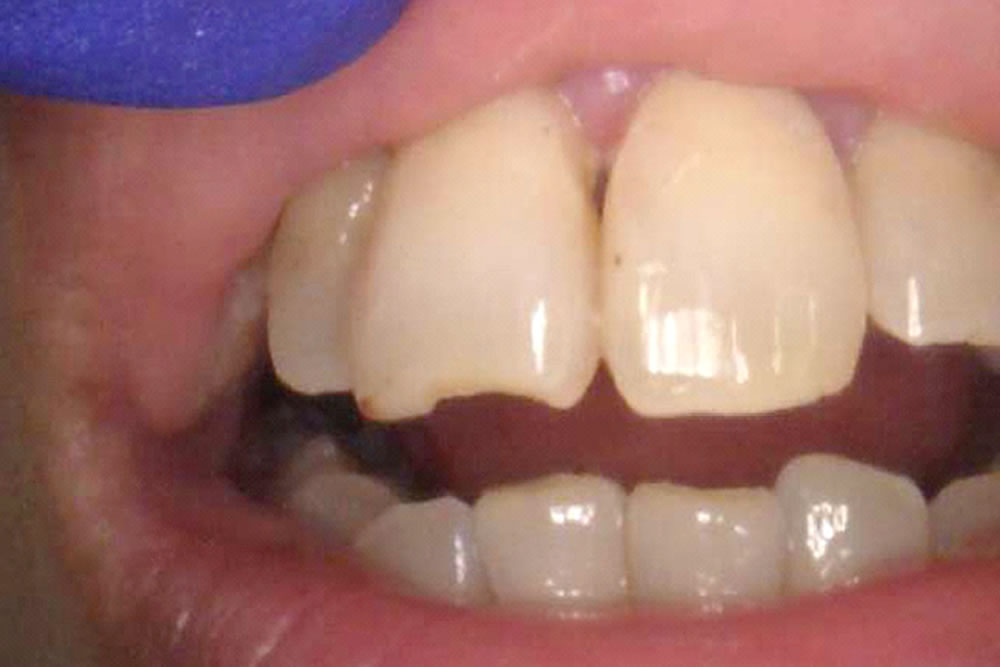 前歯切端破折の審美修復症例