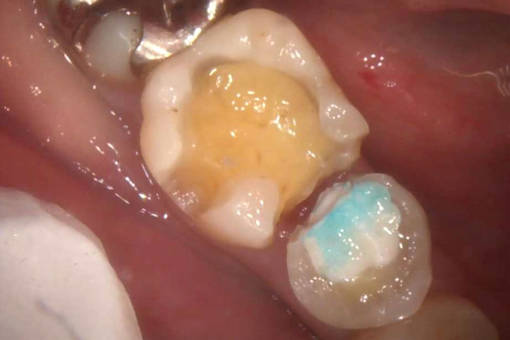 セメントと虫歯の除去
