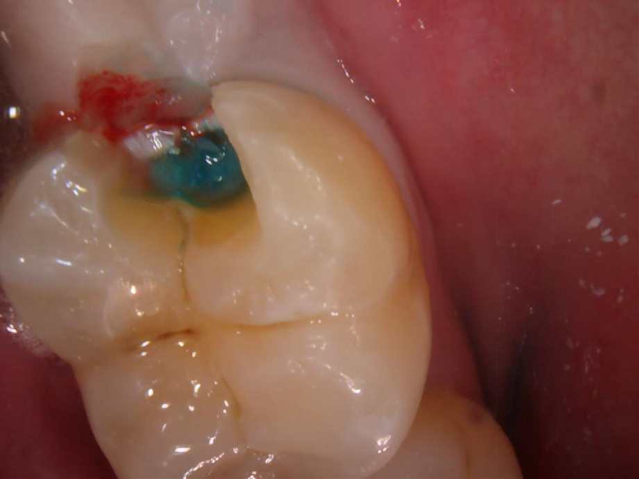 歯茎の下の虫歯