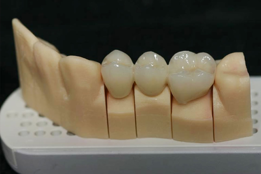 保険適用の白い歯